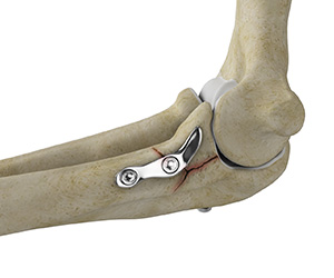 ORIF of the Coronoid Fractures Images