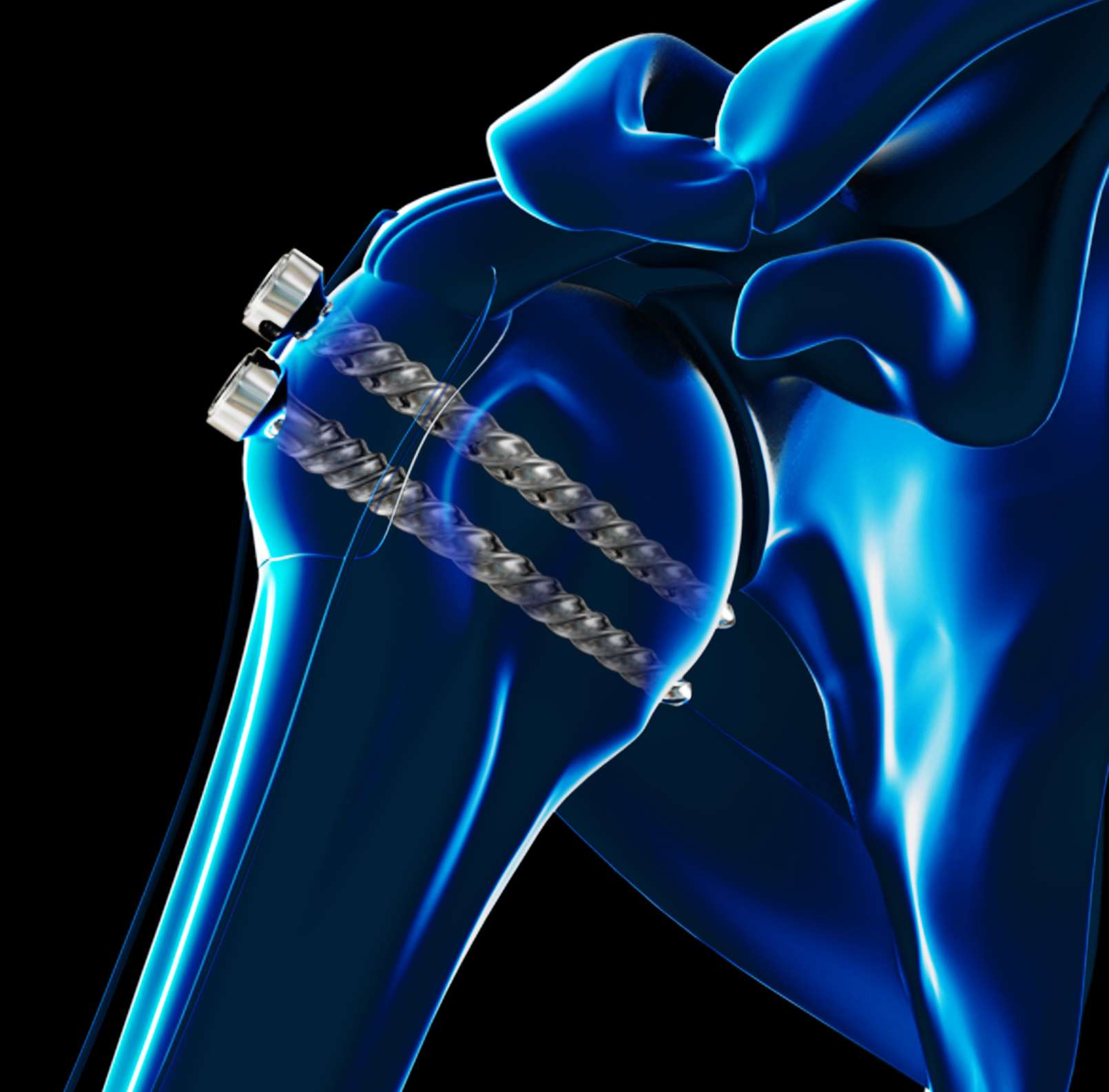 ORIF Proximal Humerus Fracture Images
