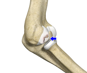 Osteochondritis Dissecans of the Elbow Images