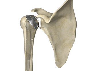 Partial Shoulder Replacement (Shoulder Hemiarthroplasty) Images