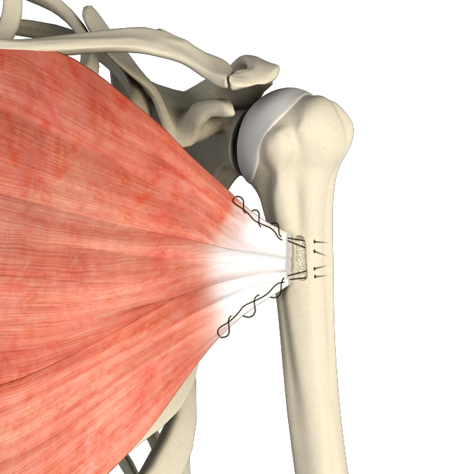 Pectoralis Tendon Repair Images