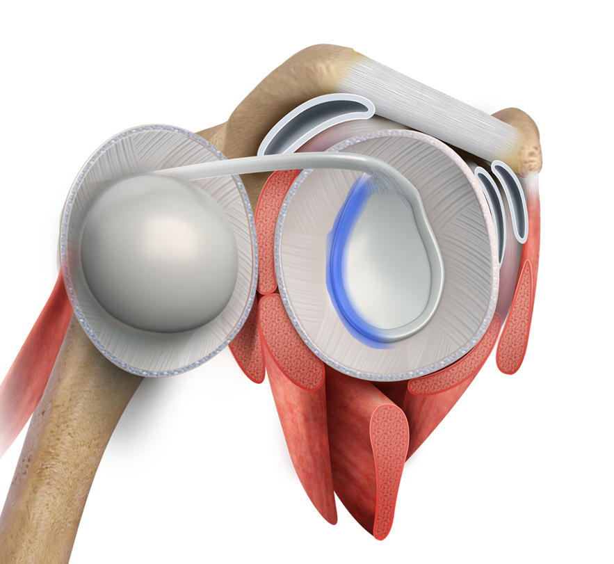 Posterior Shoulder Labral Repair Images