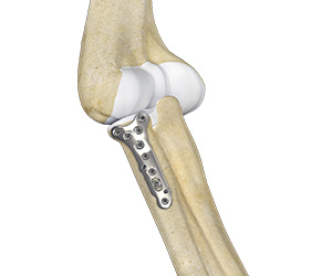 Radial Head ORIF and Replacement Images