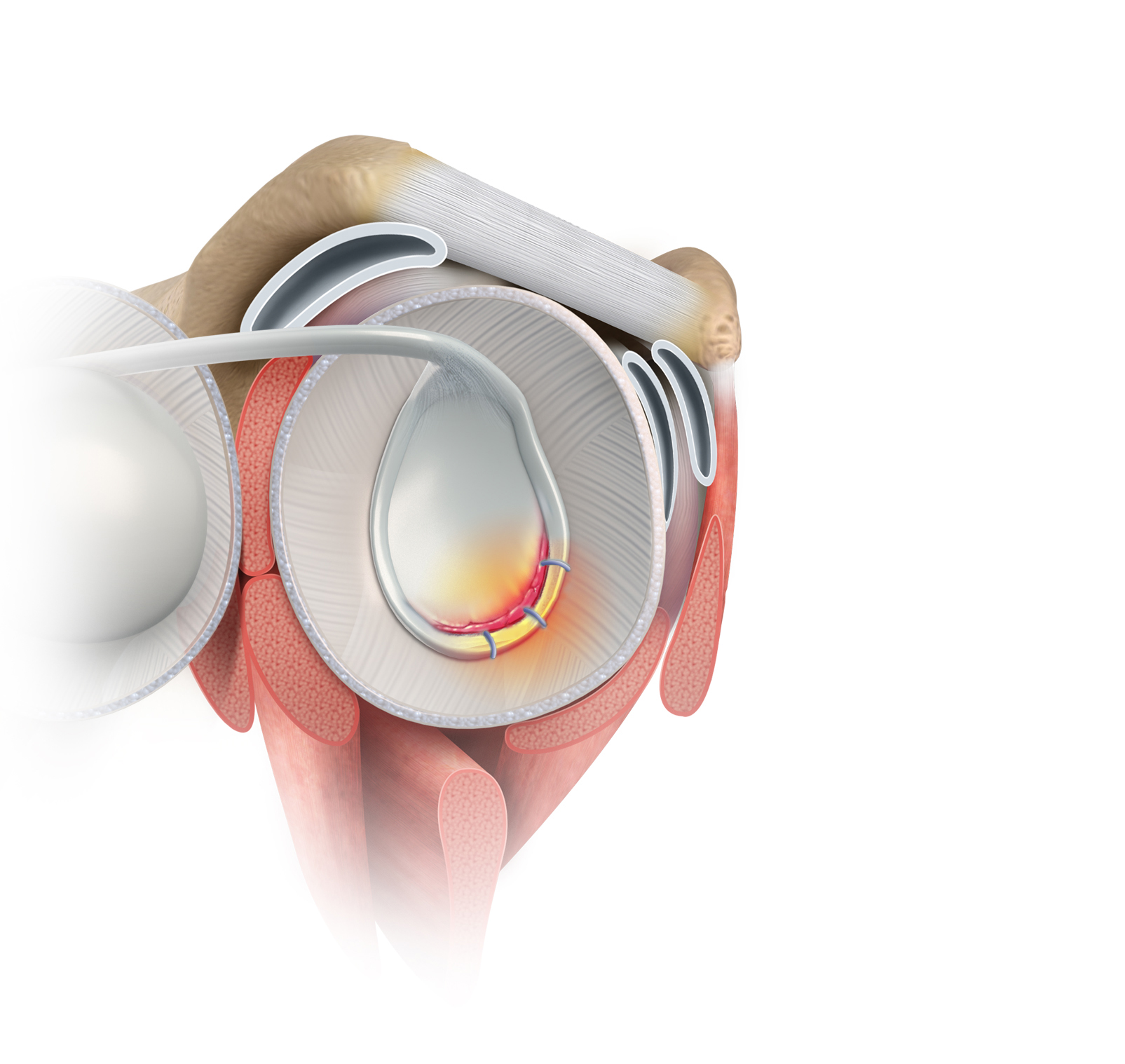 Revision Open Labral Repair (Revision Bankart) Images