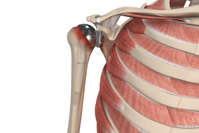 Revision Shoulder Arthroplasty Images