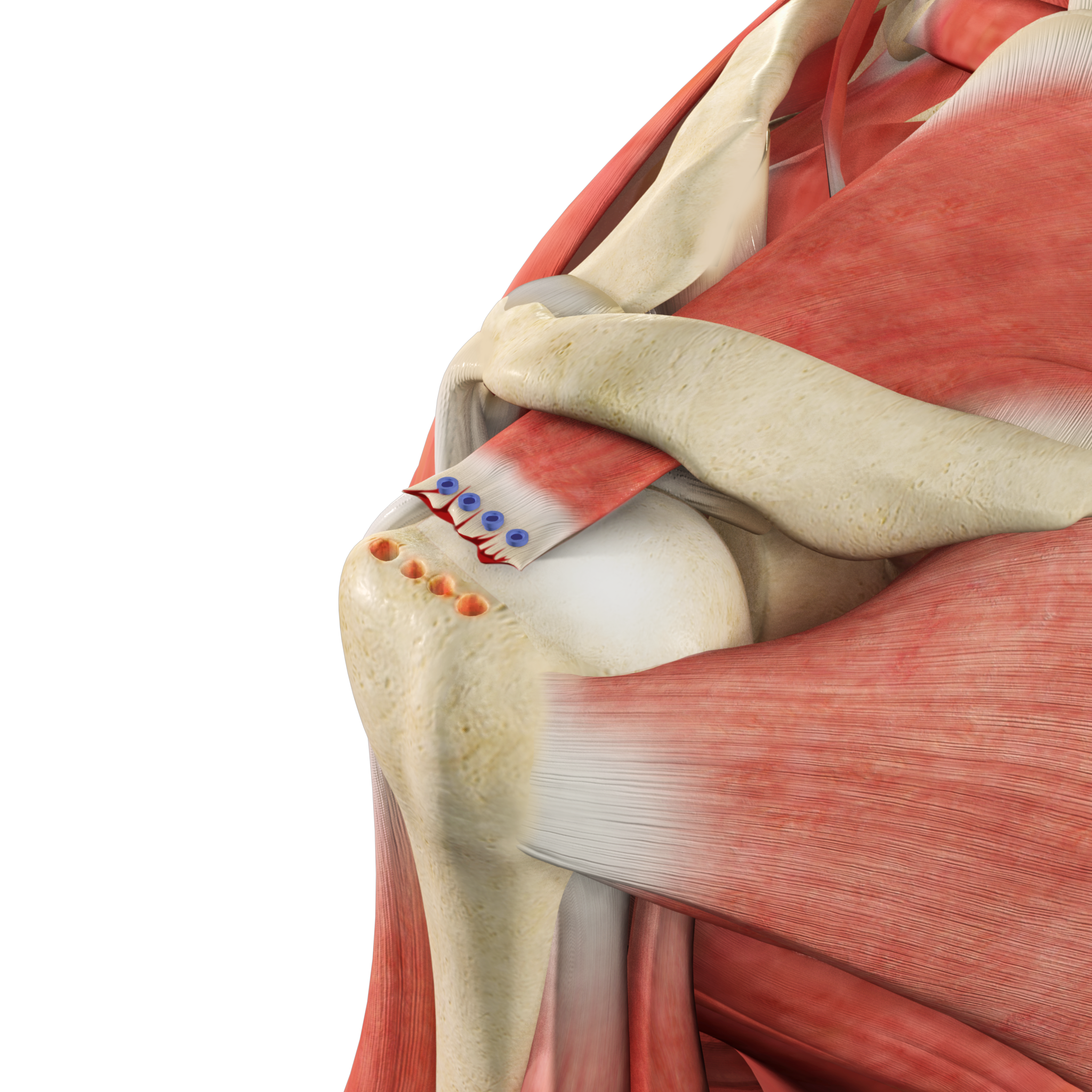 Revision Rotator Cuff Surgery Images