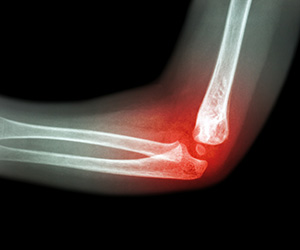 Rheumatoid Elbow Images