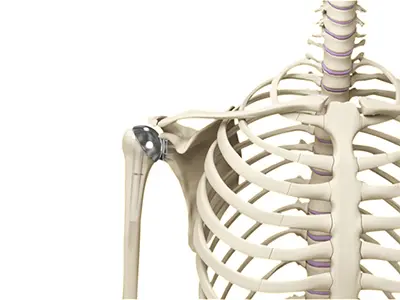 Shoulder Joint Replacement Images