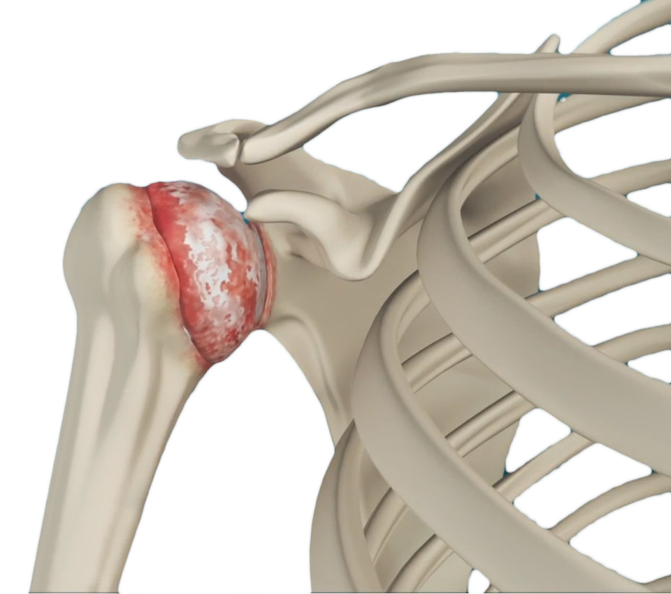 Shoulder Osteoarthritis Images
