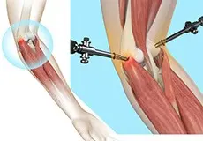 Tennis Elbow Surgery Images