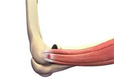 Tennis Elbow Images