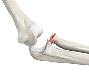 Terrible Triad of the Elbow Images