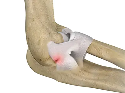 Ulnar Collateral Ligament (UCL) Injury Images