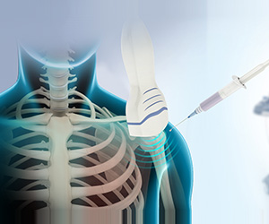 Ultrasound-Guided Shoulder Injections Images