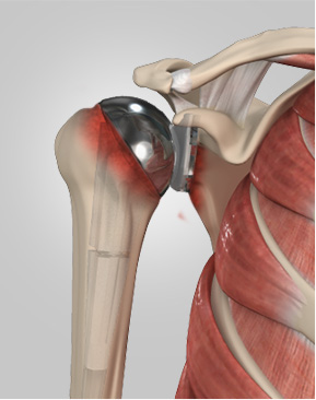 Revision Shoulder Replacement