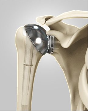 Shoulder Replacement
