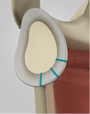 Shoulder Stabilization