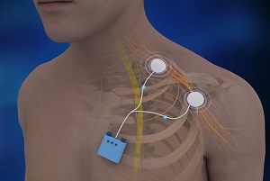 Peripheral Nerve Stimulation pic