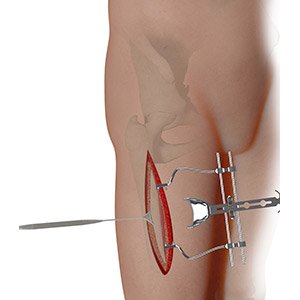 Complex Hip Reconstruction Surgery pic