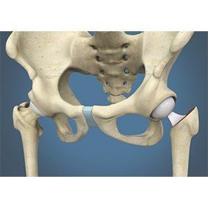 Hip Hemiarthroplasty pic