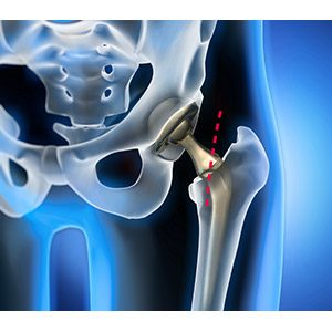 Minimally Invasive Total Hip Replacement pic