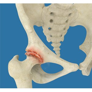 Osteoarthritis of the Hip pic