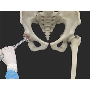 Robotic Assisted Hip Replacement pic