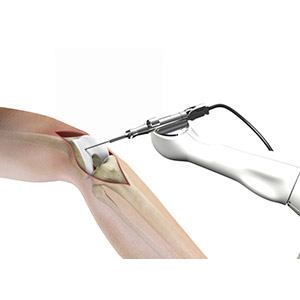 Robotic Assisted Knee Replacement pic