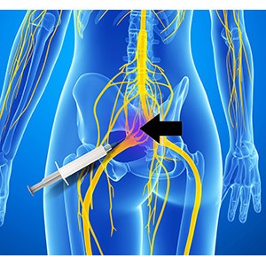 Superior Transverse Atraumatic Reconstruction (STAR) Hip Replacement pic