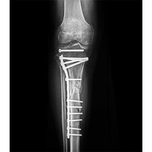 Traumatic Limb Salvage Surgery pic