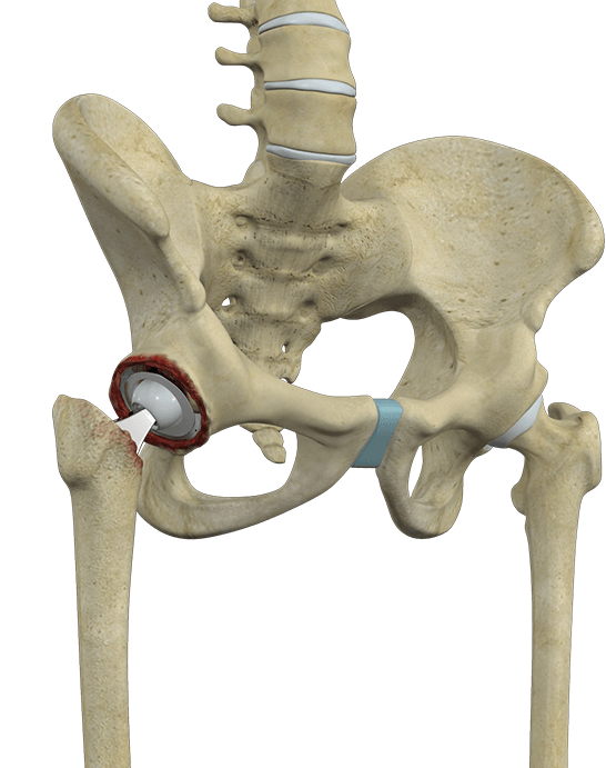 Complex Revisions of Hip and Knee Pic
