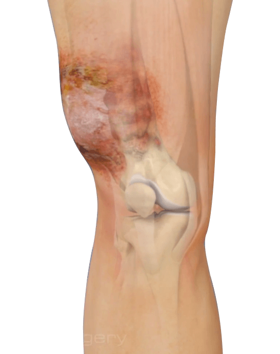 Limb Salvage Surgery Pic