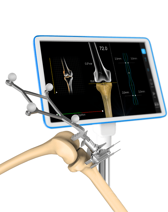 Robotic-Assisted Hip and Knee Arthroplasty Pic