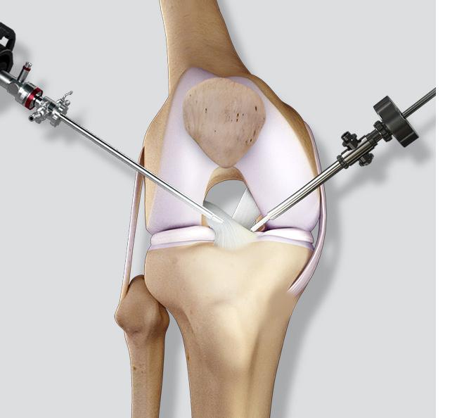 Picture of Arthroscopic Surgery