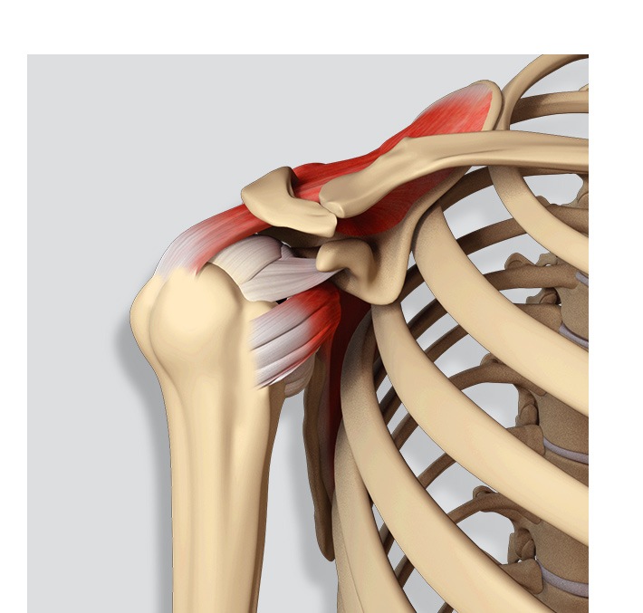 Picture of Rotator Cuff Tears