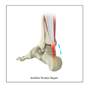Achilles Tendon Repair Educational Picture