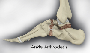 Ankle Arthrodesis Educational Picture