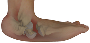 Ankle Arthropathy