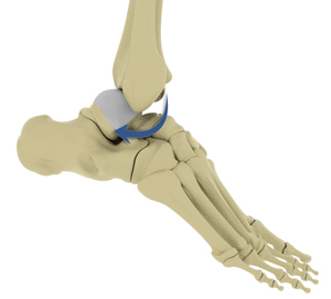 Ankle Dislocation Educational Picture