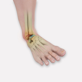 Ankle Fractures Educational Picture