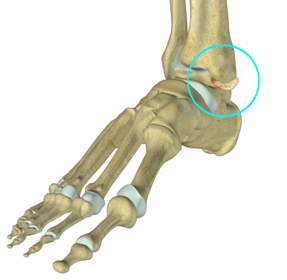 Ankle Impingement Educational Picture