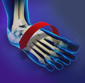 Ankle Instability Educational Picture