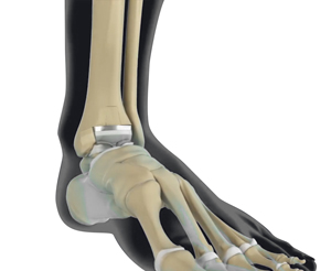 Ankle Joint Replacement using Patient-Specific Instrumentation (PSI) Educational Picture