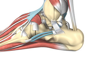 Ankle Ligament Reconstruction Educational Picture