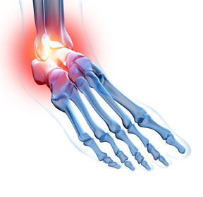 Ankle Pain Educational Picture