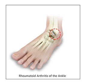 Ankle Rheumatoid Arthritis Educational Picture