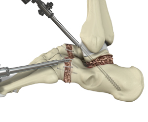 Arthroscopic Ankle Arthrodesis Educational Picture