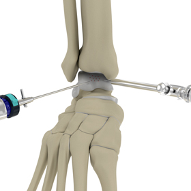 Arthroscopic Ankle Joint Cartilage Repair