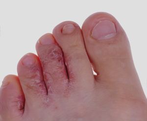 Athlete's Foot Educational Picture