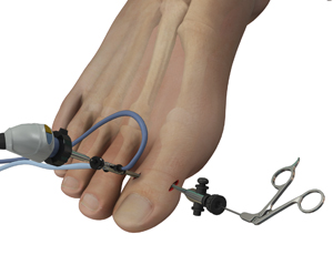 Big Toe Arthroscopy Educational Picture
